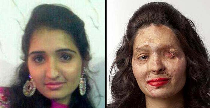 Acid attack survivor Reshma Qureshi